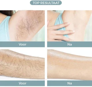 MKSS® Laser Ontharingsapparaat - IPL Ontharing - Mannen & Vrouwen - Wit