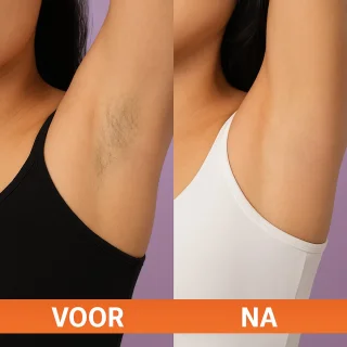 IPL laser ontharing – permanente ontharing – thuisgebruik – definitief ontharen – pijnloos met ice cooling – ontharingsapparaat – voor mannen en vrouwen – laser en lichtontharing