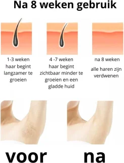 IPL Ontharingsapparaat - Roze