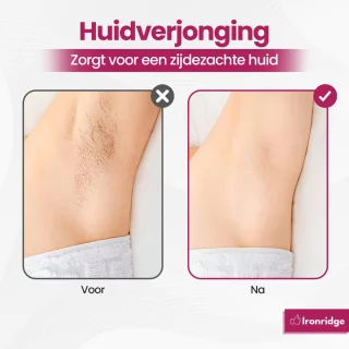 Ironridge® IPL Ontharingsapparaat