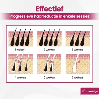 Ironridge® IPL Ontharingsapparaat