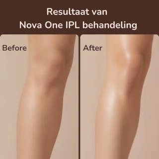 Laesera® Nova One IPL Ontharingsapparaat