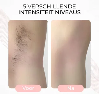 Laser IPL Epileerapparaat Dames Zwart