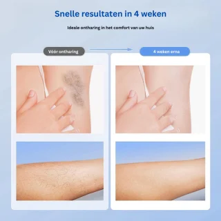 MKSS® IPL Laser Ontharingsapparaat Wit
