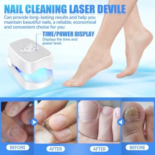 Nagelschimmel Laserapparaat