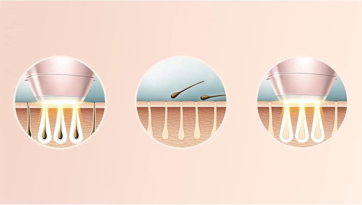 Philips IPL Lichtontharingsapparaat