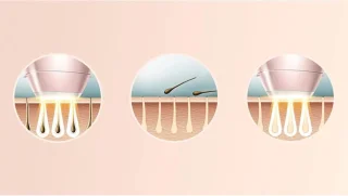 Philips IPL Lichtontharingsapparaat