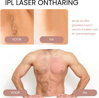 Skinalis IPL Laser Super - Lichtontharingsapparaat