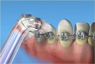Waterpik OD-100 Orthodontische Tips 2 Stuks