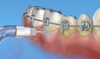 Waterpik OD-100 Orthodontische Tips 2 Stuks